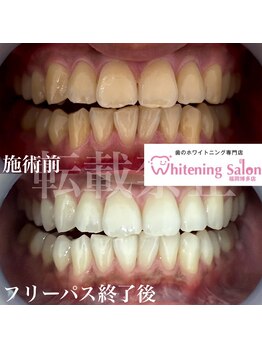 ホワイトニングサロン 福岡博多店/ホワイトニング