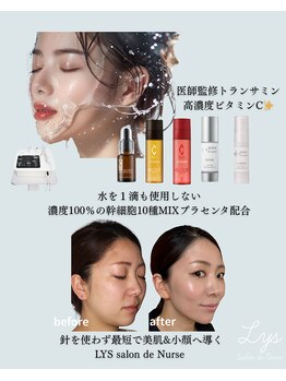 リスサロンドナース(LYS salon de Nurse)/水光肌♪メソ導入ポレーション