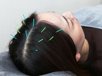 イナリ鍼灸マッサージ院(inare鍼灸マッサージ院)の写真/自律神経を整え、眠りの質UP！頭の鍼と電気で小顔へ導く♪朝がスッキリしないあなたに◎