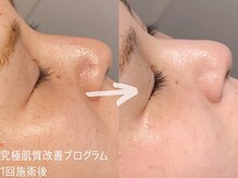 ルーナジェーナ(Luna llena)/究極の肌質改善プログラム