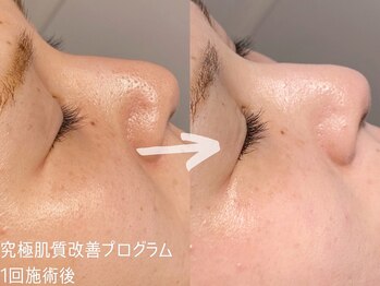 ルーナジェーナ(Luna llena)/究極の肌質改善プログラム