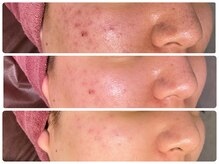 ハーブピーリング 恵比寿/ハーブピーリング/肌質改善