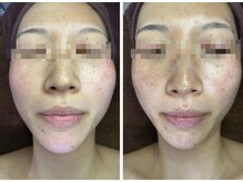 オリ(Oli)/最強フェイシャル3点セット