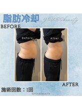 ユアーズ ビューティー(YOURS beauty)/脂肪冷却