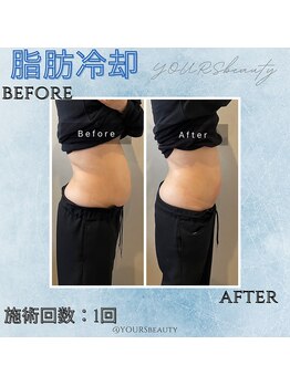ユアーズ ビューティー(YOURS beauty)/脂肪冷却