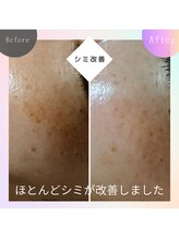 ロコモ 美容矯正サロン(Locomo)/目の下頬まわりのシミ改善！