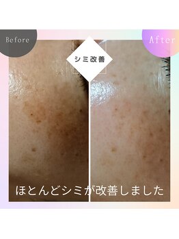 ロコモ 美容矯正サロン(Locomo)/目の下頬まわりのシミ改善！