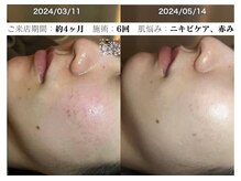 お顔ラボ AOYAMA(お顔LABO)/スキングローピール6回のお客様