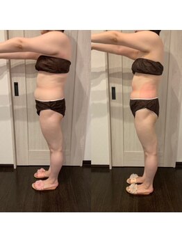 エステサロン ロティオン/医師監修脂肪冷却