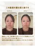東洋医学・解剖学・生理学に基づいた顔はり施術（幹細胞付き）
