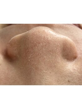 毛穴ケアをしたい