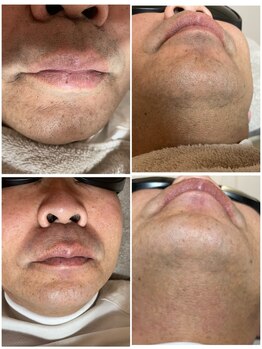 シャイニースキン(Shiny skin)の写真/男性も脱毛する時代★気になるムダ毛を徹底ケア!最新機器の脱毛で清潔感のあるデキる男の身だしなみに♪