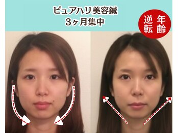 ピュアハリ/沖縄美容鍼/たるみ/効果