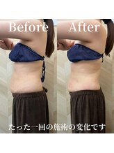 介正鍼灸整骨院 整体院 エフコープ大野城店/痩身エステ／ビフォーアフター