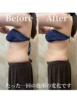 介正鍼灸整骨院 整体院 エフコープ大野城店/痩身エステ／ビフォーアフター