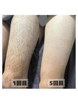 カナウ(KANAU)の写真/【全身脱毛（顔かVIOを選択する）が8,900円で♪】脱毛をしながらザラザラ毛穴と肌荒れを改善できます◎