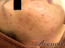 アクール(Accueil)/毛穴ケア/肌質改善/ニキビケア