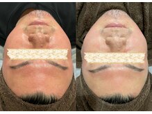 ラヴィアンローズ 泉店 (La vie en Rose)/シリカハーブピーリング