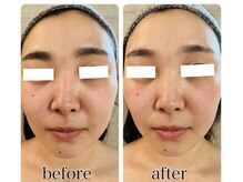 ニコリ(nicori)/小顔矯正　結果写真