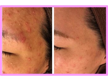 ハリス(HARIS)/デコボコが無くなる変化