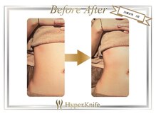 シュシュ(chouchou)の雰囲気(ハイパーナイフ正規取扱店。即効性、持続性NO1!)