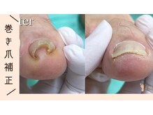 巻き爪補正店 那覇店/
