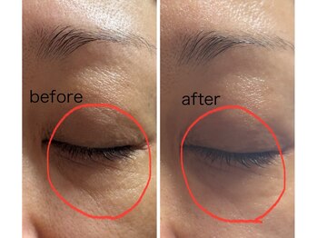 スーコ(SU:CO)/レモンボトル　目元たるみ＆しわ