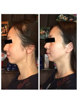 ぐりーんりぷる/金箔エステ1回の変化！