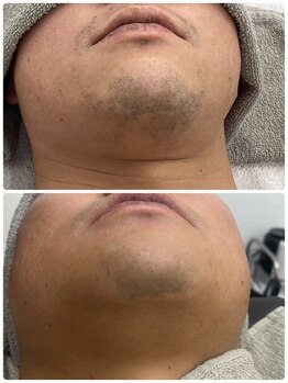 テソロ(Tesoro.)/メンズ顔脱毛