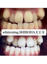 シロハ(SHIROHA)/セルフホワイトニング/天王寺