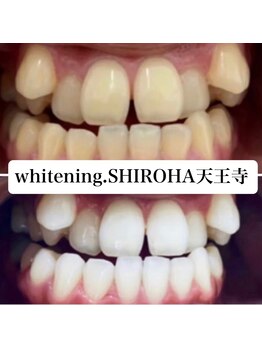 シロハ(SHIROHA)/セルフホワイトニング/天王寺