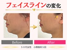タイナ(taina)/50代女性/小顔施術5回