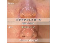 メグル(MEGURU)の雰囲気（プラチナクレイピール2回メラミースキンケア使用）