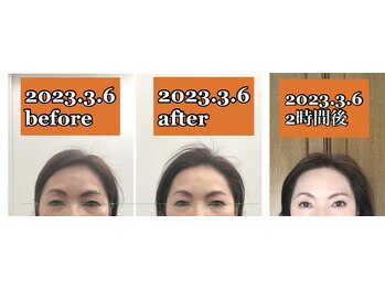 ハーボプラス(THE HEARBO plus)/施術例12