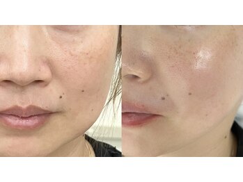 デルタヌー(deltanuu)/韓国美肌ワックス