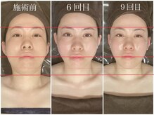 千歳の女神 久屋大通店/【施術風景】Berore/After