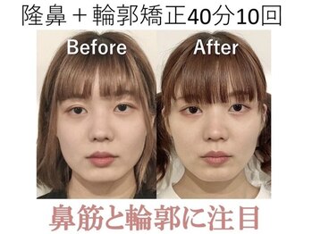 ラプリ 梅田店(Raplit)/隆鼻＋輪郭矯正40分10回