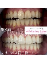 ホワイトニングサロン 福岡博多店/ホワイトニング