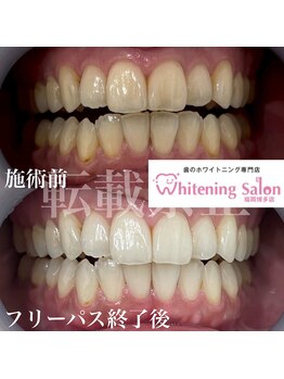 ホワイトニングサロン 福岡博多店/ホワイトニング