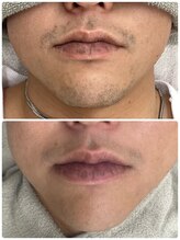 テソロ(Tesoro.)/メンズ顔脱毛