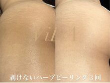 ヴィーダ 渋谷松濤(ViDA)/お尻の黒ずみ/ザラつき改善