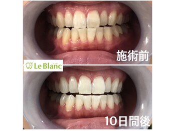 ルブラン 奈良店(Le Blanc)/短期間で白い歯に！