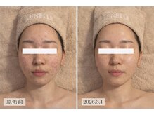 ルネル(Lunelle)/ハーブピーリングでニキビ肌卒業