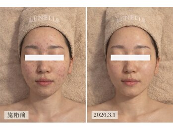 ルネル(Lunelle)/ハーブピーリングでニキビ肌卒業