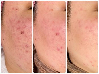 ハーブピーリング 恵比寿/ハーブピーリング/ニキビケア