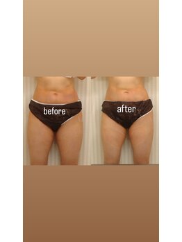 エステサロン ロティオン/医師監修脂肪冷却