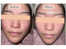 リファラ 光の森店(REFALA)/毛穴・ニキビケア専門REFALA