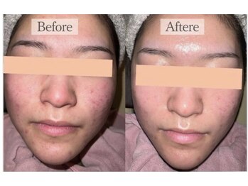 リファラ 光の森店(REFALA)/毛穴・ニキビケア専門REFALA