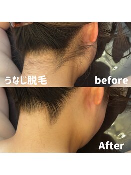 ブルームーン(BLUE MOON)/うなじ脱毛デザインシェービング