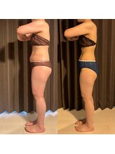 カシェット(cachette)/ウルトラ全身痩身